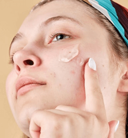 Chica con acné aplicandose crema