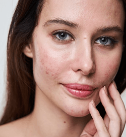 Chica con visibles granos en la cara